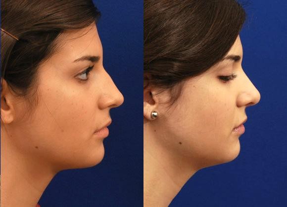 Hilger Face Center nose job before and after, Minneapolis and Edina