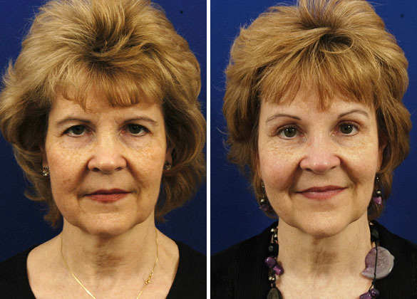 Hilger Face Center Brow Lift Surgery before and after