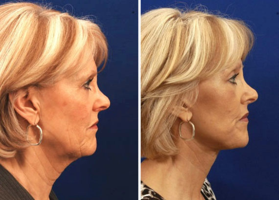 Facelift before and after photos, Hilger Face Center Minneapolis and Edina
