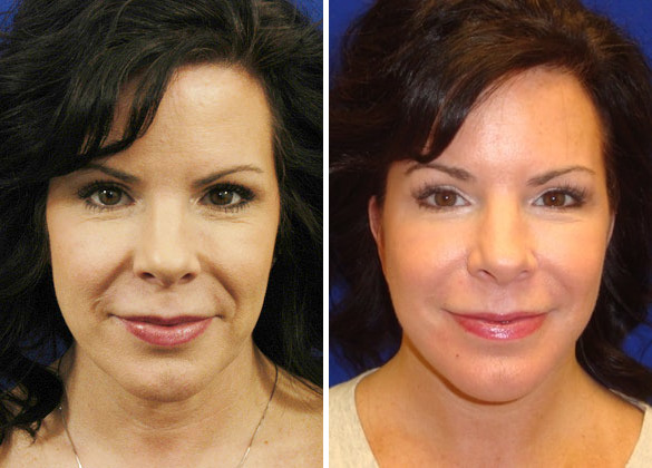 Hilger Face Center Facelift before and after