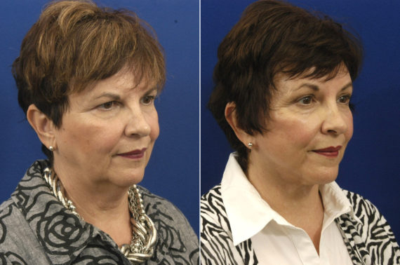Facelift before and after Hilger Face Center, Minneapolis and Edina