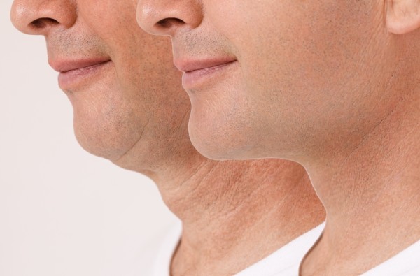 Chin Augmentation Hilger Face Center Minneapolis