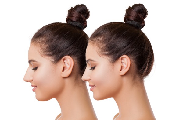 Rhinoplasty