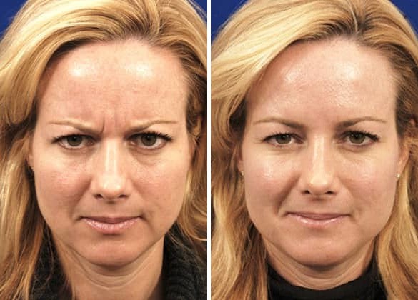 Hilger Face Center fillers and Botox Before and After, Minneapolis and Edina