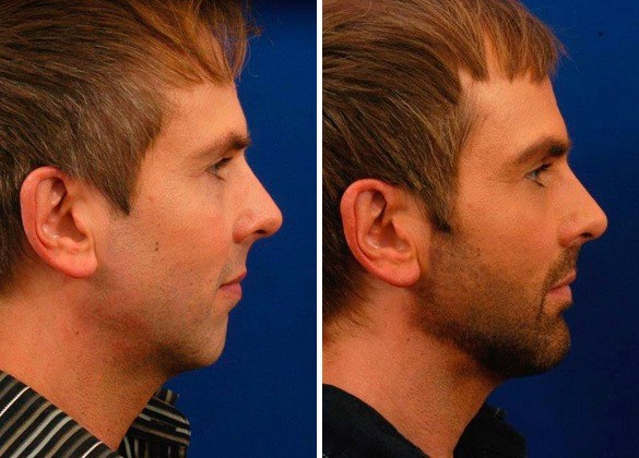 Hilger Face Center Chin Augmentation Before and after
