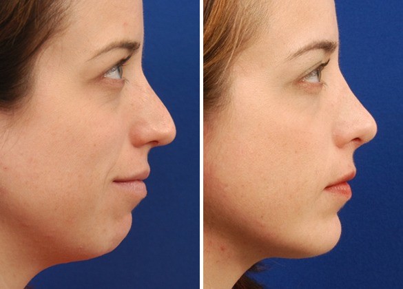Hilger Face Center Chin Implant Before and after