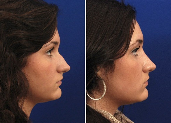 Rhinoplasty before and after Hilger Face Center Minneapolis and Edina