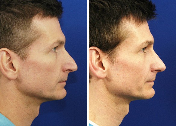 Hilger Face Center Rhinoplasty before and after Minneapolis and Edina