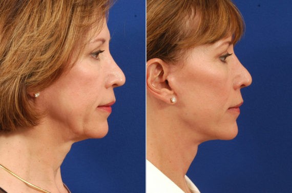 Hilger Face Center Facelift before and after, Minneapolis and Edina