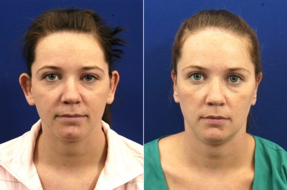 Otoplasty before and after, Hilger Face Center Minneapolis and Edina