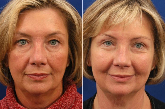 Eyelid lift before and after blepharoplasty before and after, Hilger Face Center Minneapolis and Edina