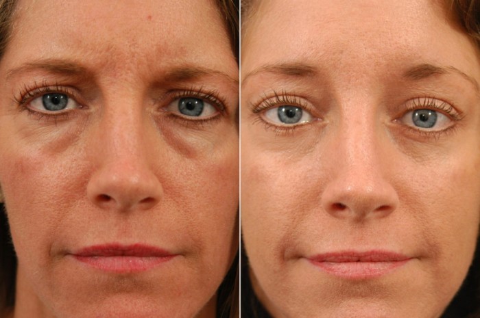 Eyelid lift before and after blepharoplasty before and after, Hilger Face Center Minneapolis and Edina