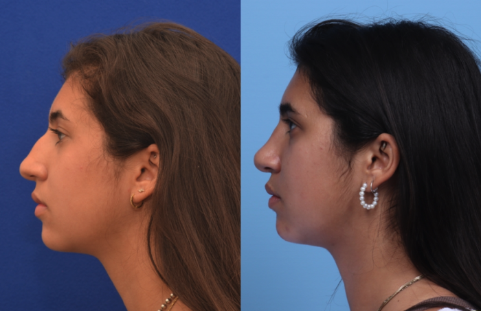 Hilger Face Center Rhinoplasty Before and After 2022, Minneapolis and Edina