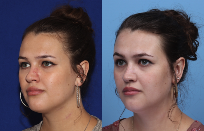 Hilger Face Center Dermabrasion Before & After 2022, Minneapolis and Edina